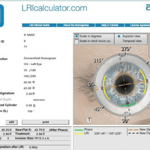 Limbal Relaxing Incision Online Nomogram