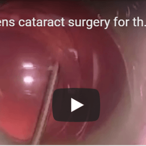 Video  Bag in the Lens insertion/ Performance of PCCC - M Tassignon